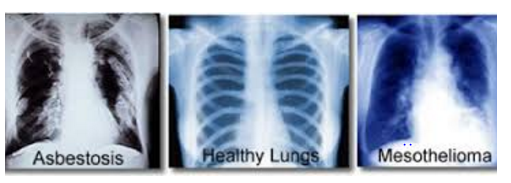 Skärmklipp-asbestos lungs